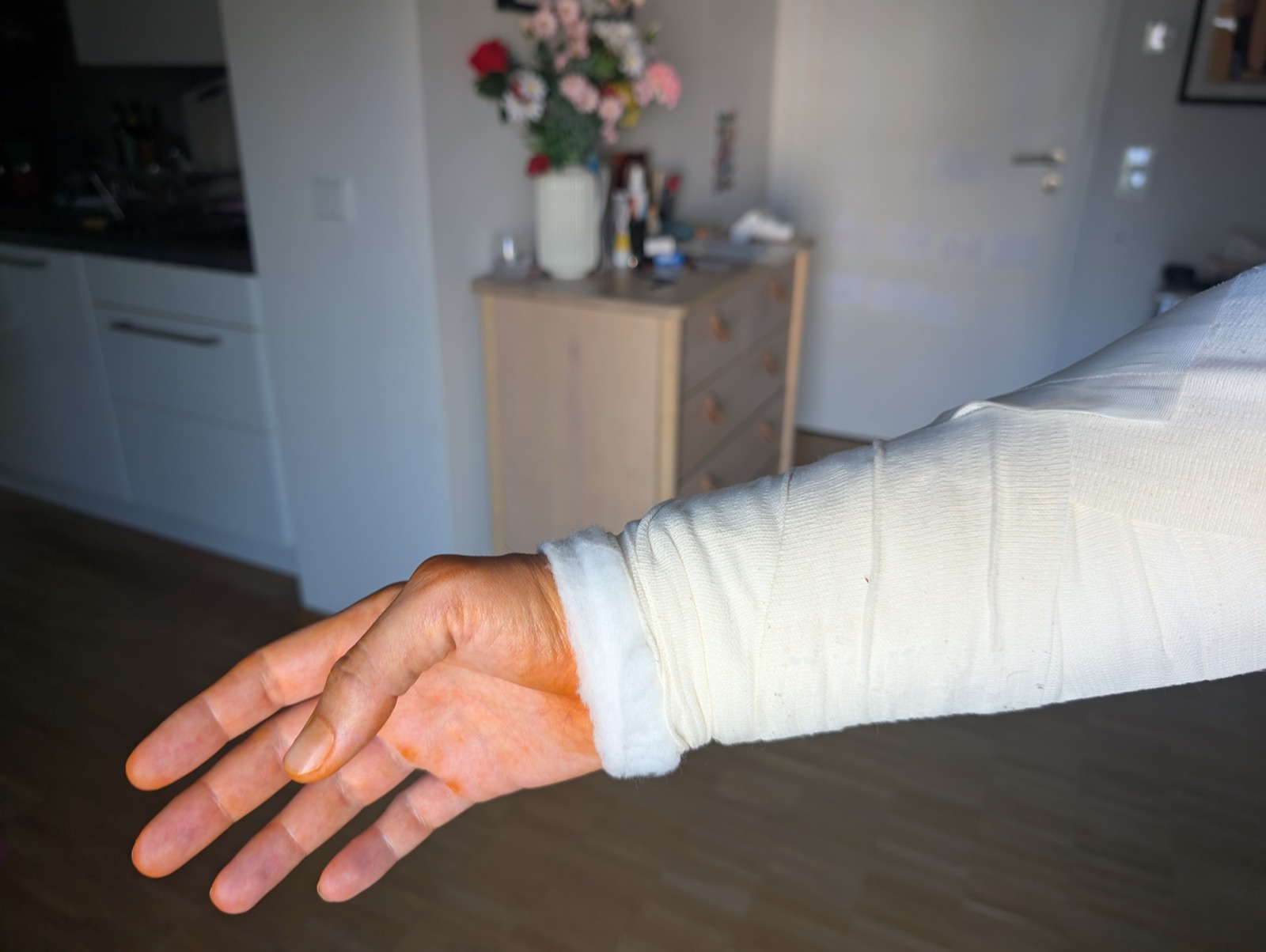 Ich mit der Gipsschiene am rechten Arm in den ersten Tagen nach der Operation